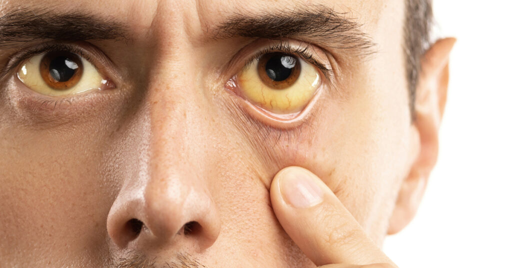 اللجان الشعبية تحذر من إنتشار الكبد الوبائي